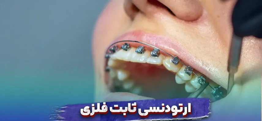 ارتودنسی ثابت فلزی چیست و چه مزایا و معایبی دارد؟