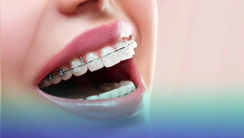 ارتودنسی سرامیکی از انواع ارتودنسی ثابت