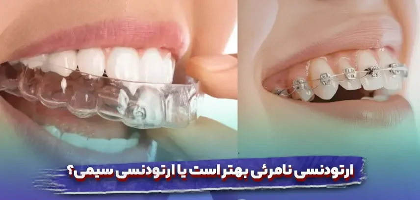 ارتودنسی نامرئی بهتر است یا سیمی؟ کدام را انتخاب کنیم؟
