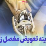 هزینه تعویض مفصل زانو